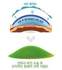 컨투라비전 수술 방법 4